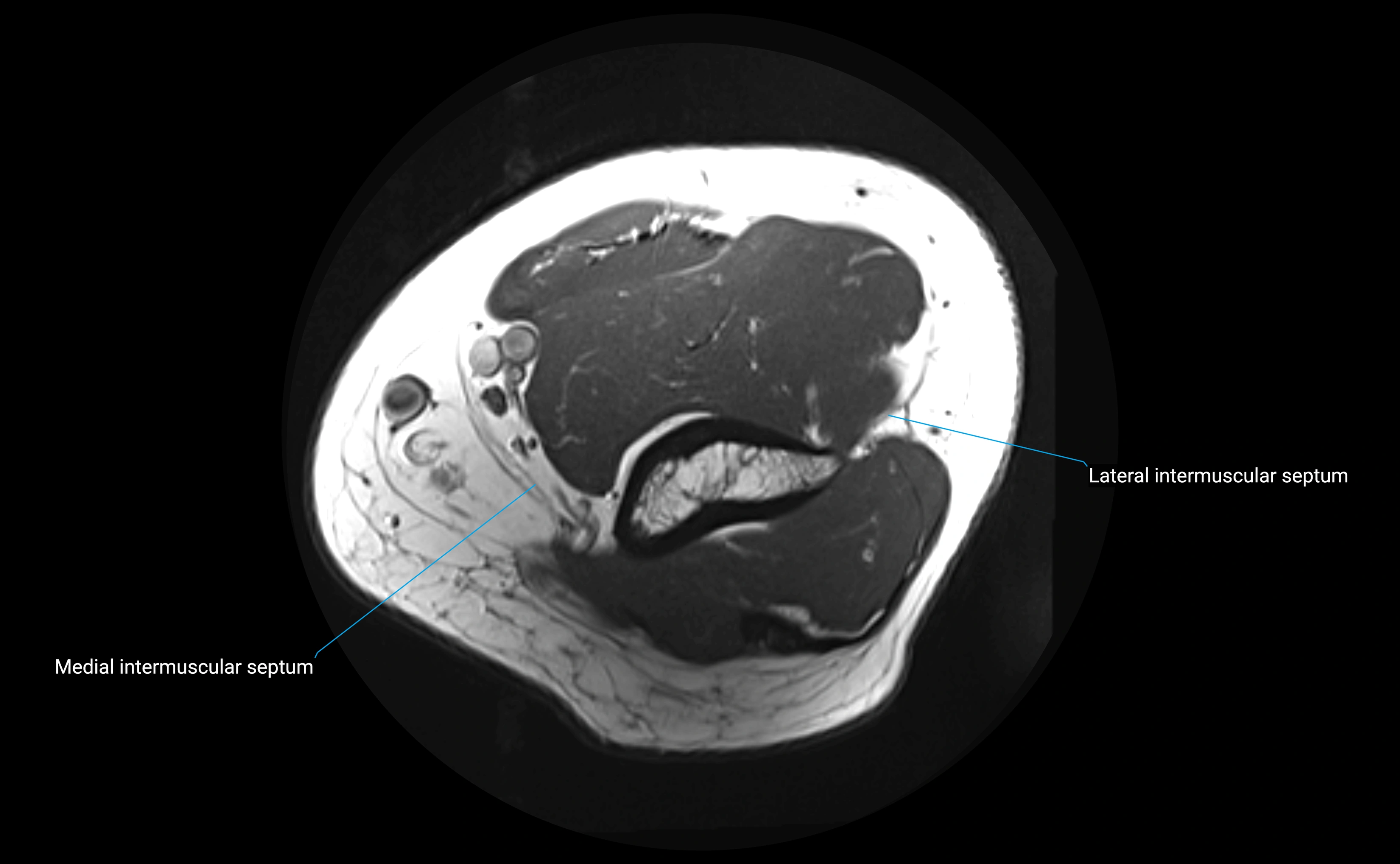MRI elbow ligaments axial cross sectional anatomy 3T  radiology  image-img-00001-00005.webp